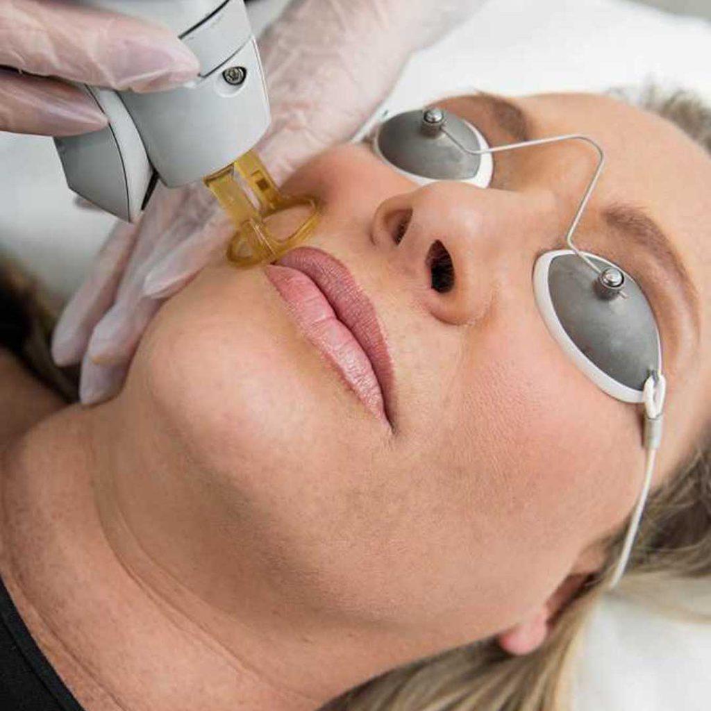 لیزر موهای زائد صورت پوست را می سوزاند ؟