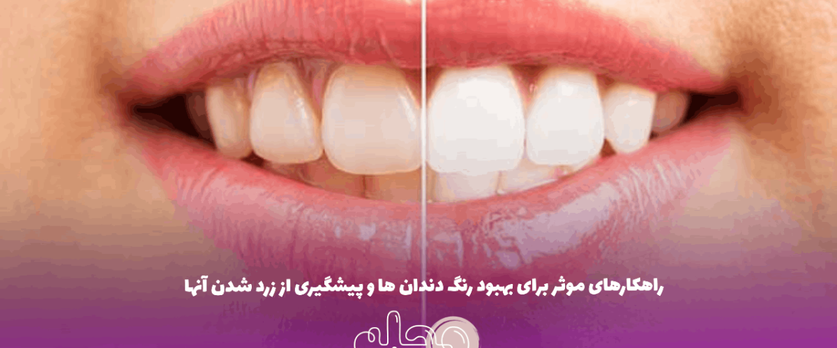 راهکارهای موثر برای بهبود رنگ دندان ها و پیشگیری از زرد شدن آنها