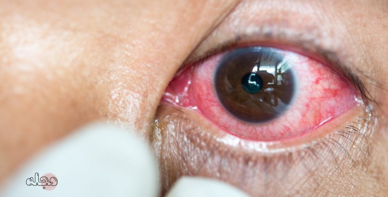 اعتماد کردن به قطره های کاهش قرمزی چشم