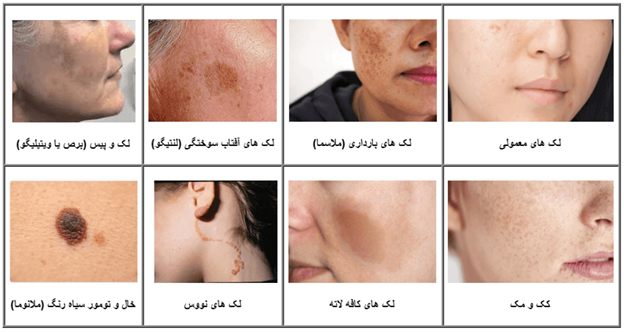 انواع لک صورت کدامند؟