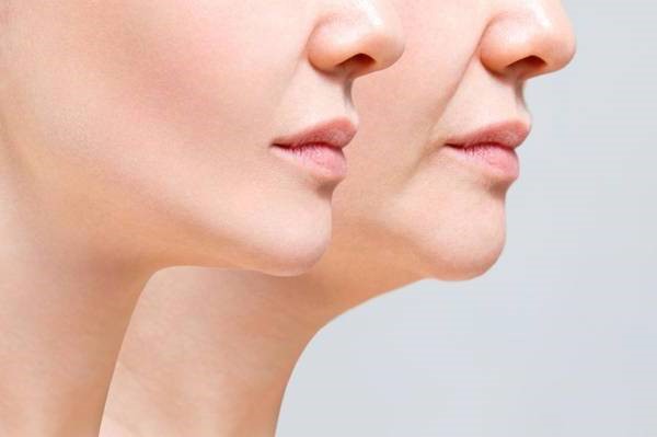 مراحل درمان آر اف 