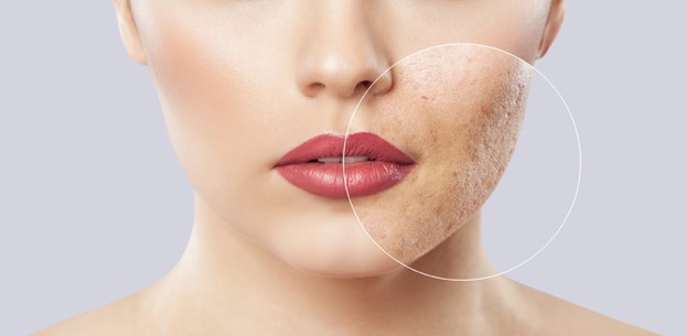 نحوه انجام آر اف 