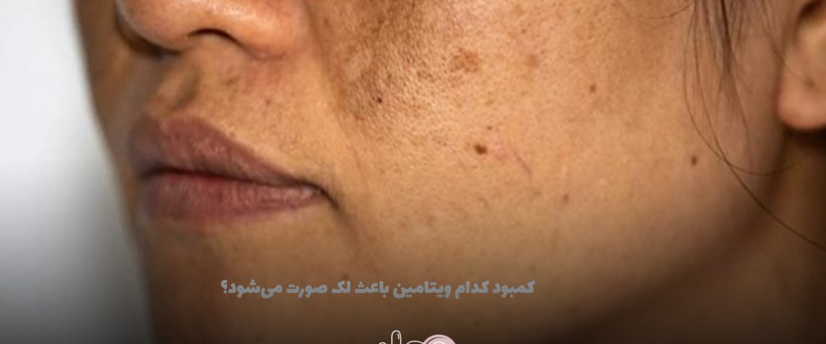 کمبود کدام ویتامین باعث لک صورت میشود؟