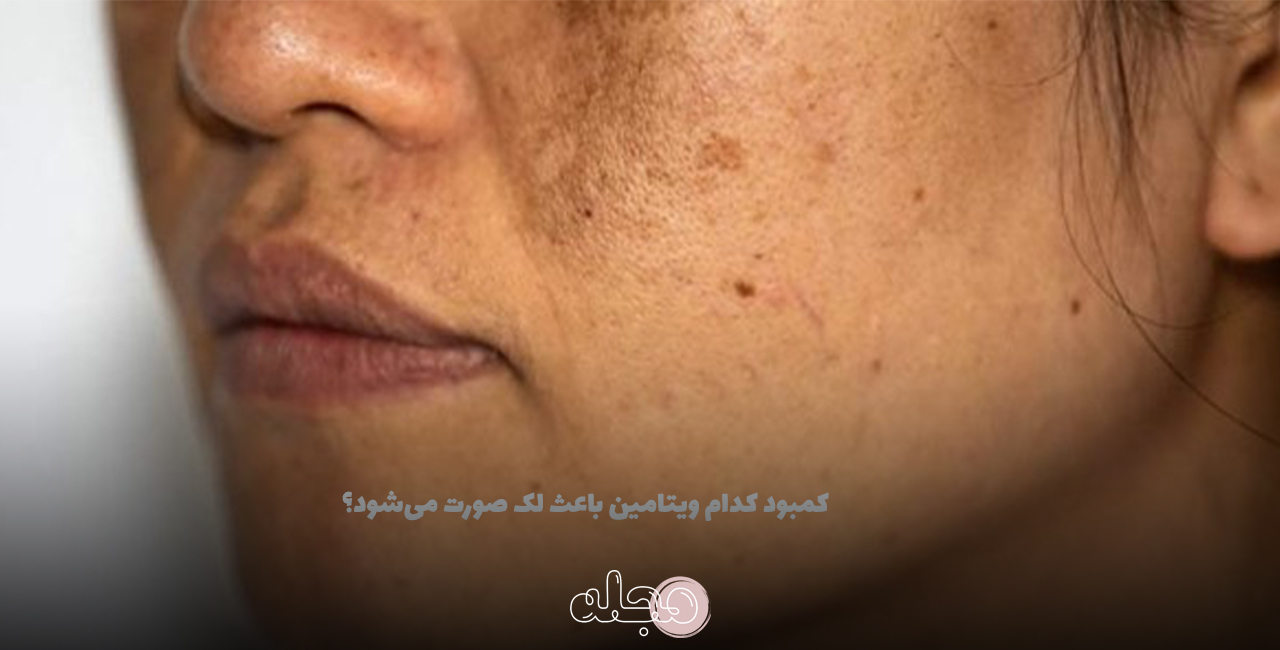 کمبود کدام ویتامین باعث لک صورت می‌شود؟